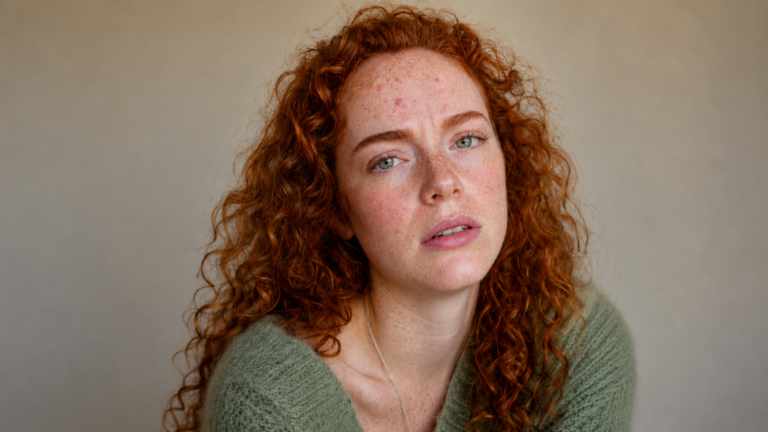 “Why Your Chin & Jaw Acne Won’t Go Away (It’s Not What You Think)”.