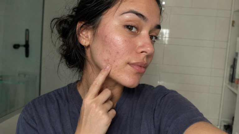 “I Stopped Using Benzoyl Peroxide & Antibiotics — My Skin Microbiome Was the Real Problem (Here’s What Fixed My Acne Instead)”