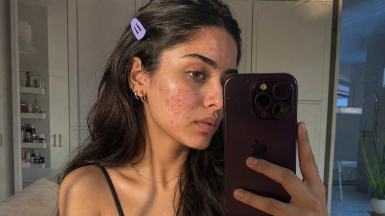 DIM for Hormonal Acne: I Took DIM Supplements for 30 Days Instead of Treating My Hormonal Acne Topically — Here’s What the Science Says